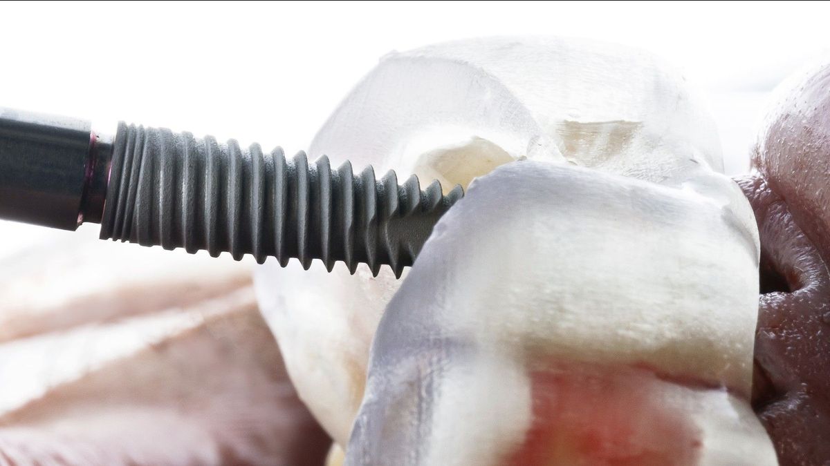 Chirurg v Turecku natlačil pacientovi zubní implantát až do mozku
